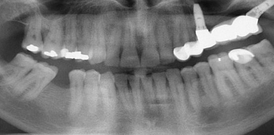 Rehabilitation of the 2nd sextant with tuberositary - Dr. Ana Ferro