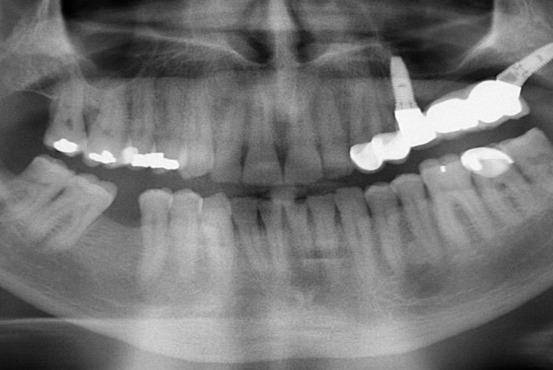 Rehabilitation of the 2nd sextant with tuberositary - Dr. Ana Ferro