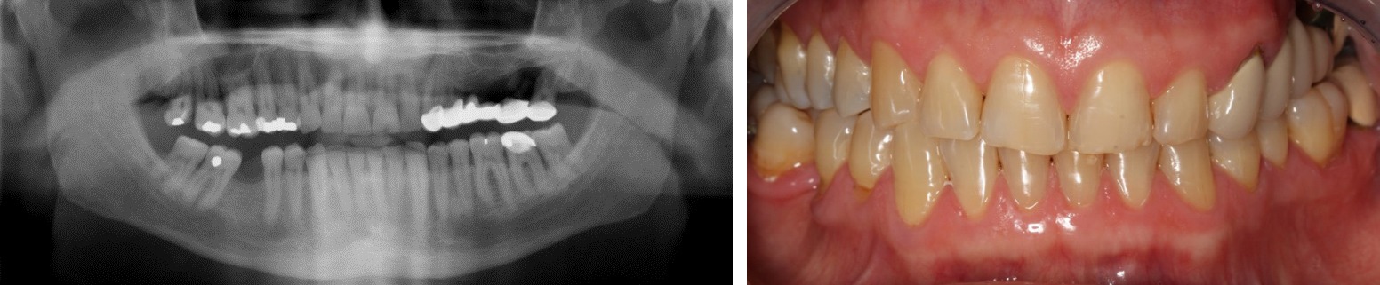 Rehabilitation of the 2nd sextant with tuberositary - Dr. Ana Ferro