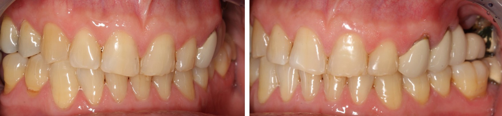 Rehabilitation of the 2nd sextant with tuberositary - Dr. Ana Ferro