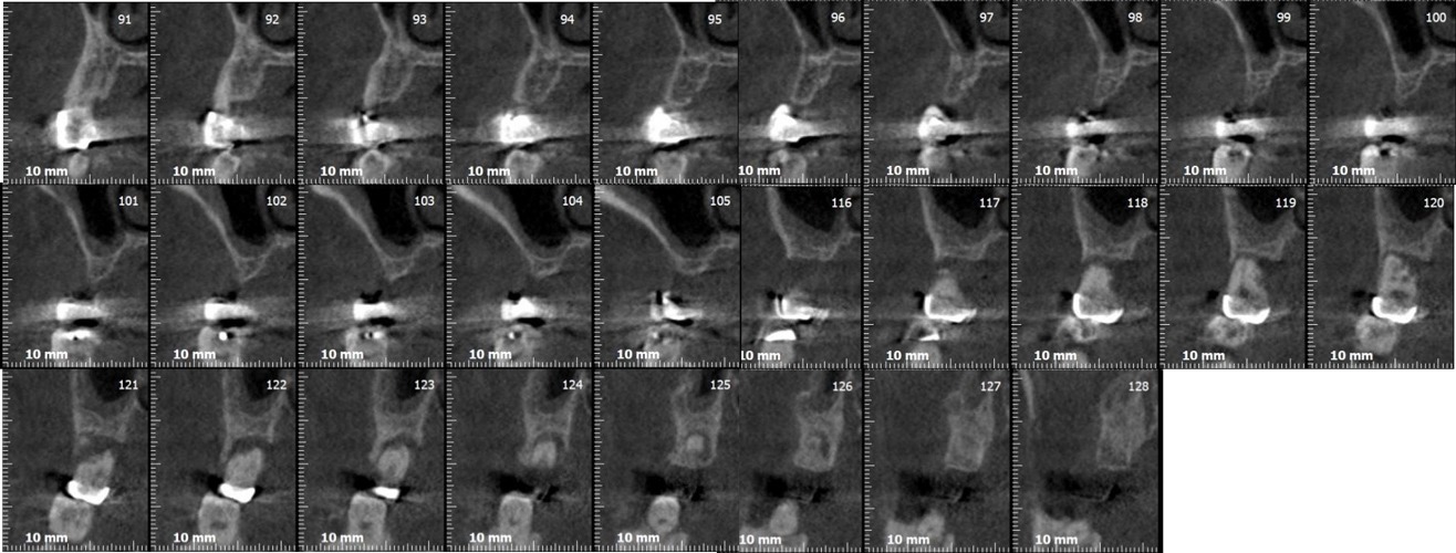 Rehabilitation of the 2nd sextant with tuberositary - Dr. Ana Ferro