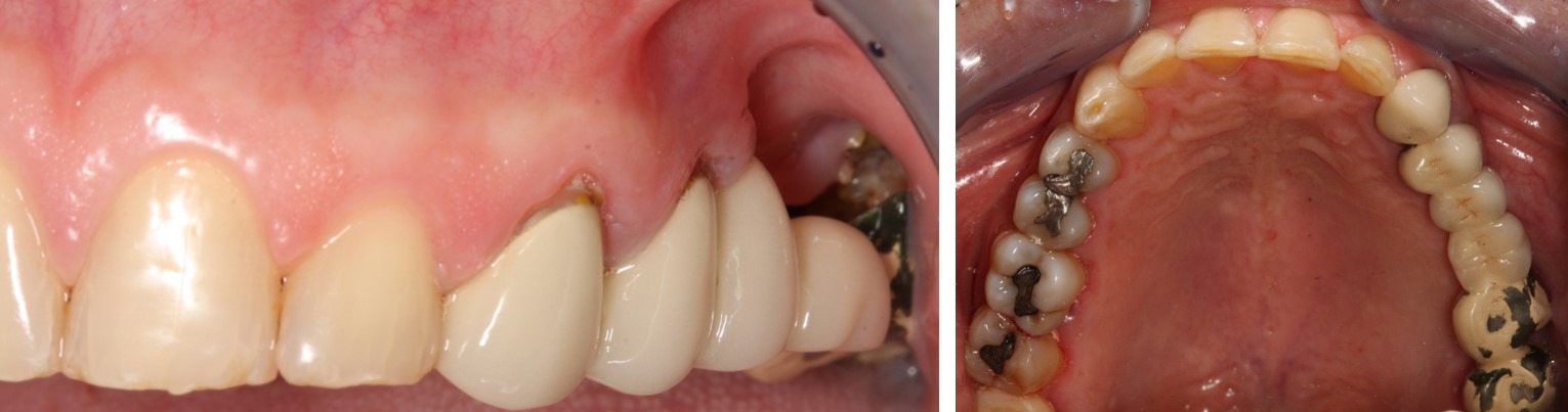 Rehabilitation of the 2nd sextant with tuberositary - Dr. Ana Ferro