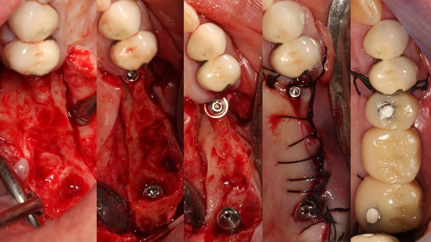 Rehabilitation of the 2nd sextant with tuberositary - Dr. Ana Ferro