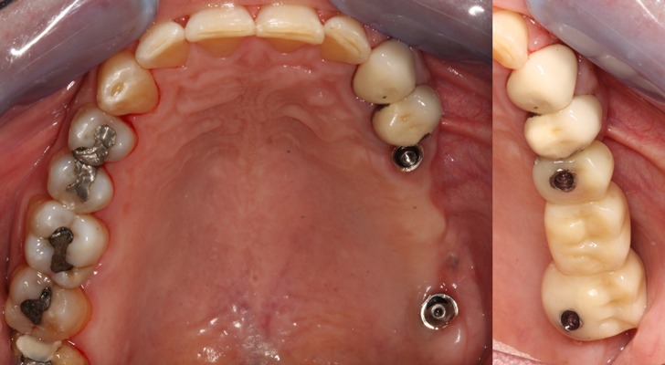 Rehabilitation of the 2nd sextant with tuberositary - Dr. Ana Ferro