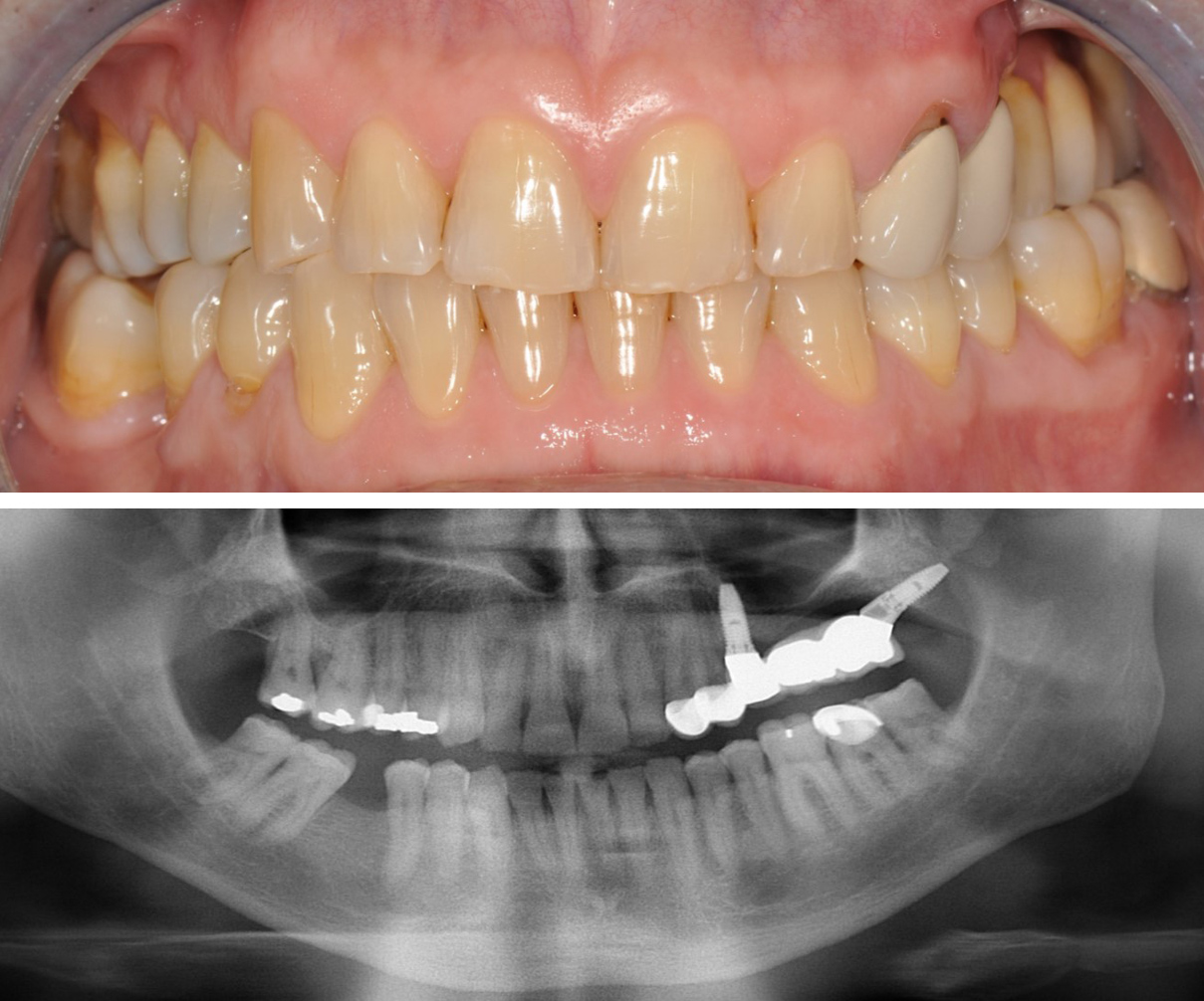 Rehabilitation of the 2nd sextant with tuberositary - Dr. Ana Ferro