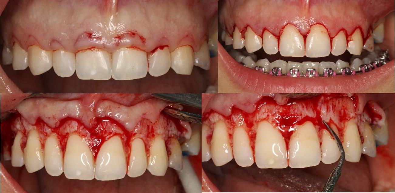 Periodontal Plastic Surgery - Dr. Ana Ferro | MALO CLINIC