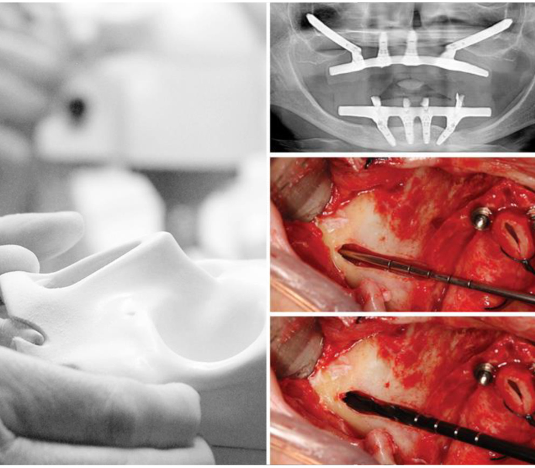 Cadaver Course | All-on-4® Surgical Course - Dr. Ana Ferro MALO CLINIC