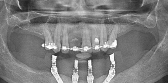 All-on-4 Mandible – Immediate function