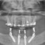 All-on-4 Mandible – Immediate function