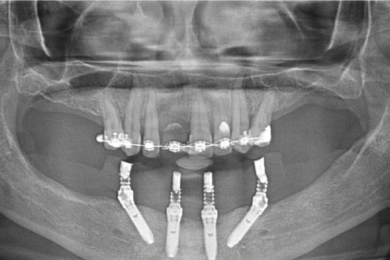 All-on-4 Mandible – Immediate function