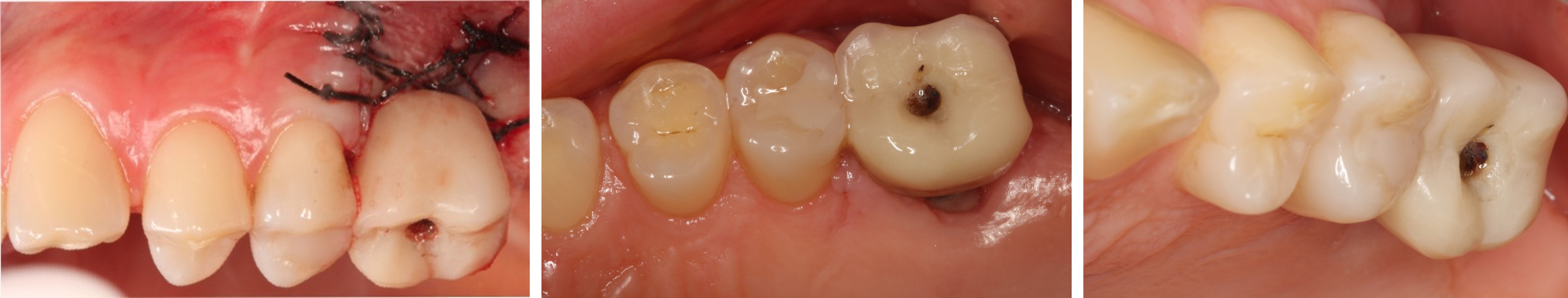 Rehabilitation of #26 with sinus lift prior to extraction - Immediate function