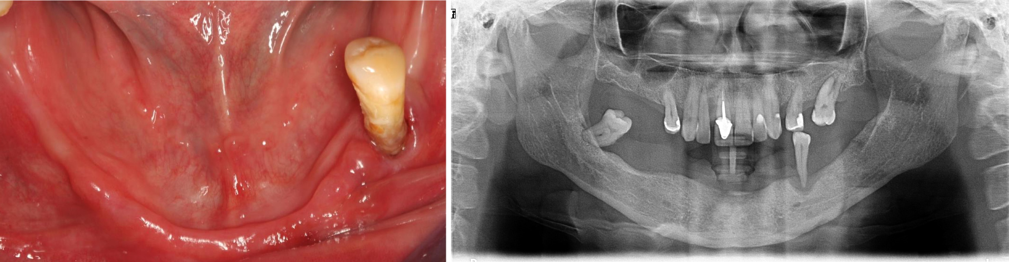 All-on-4 Mandible – Immediate function