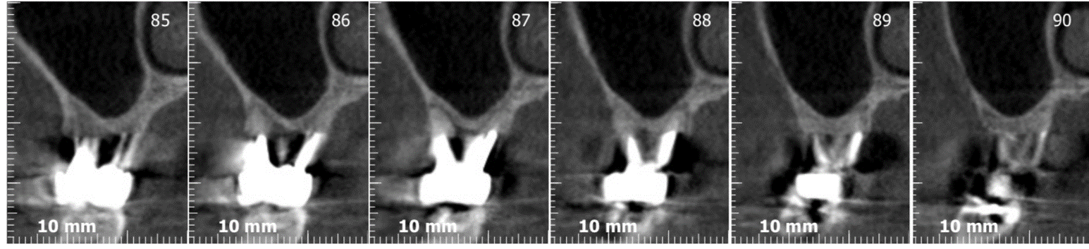 Rehabilitation of #26 with sinus lift prior to extraction - Immediate function