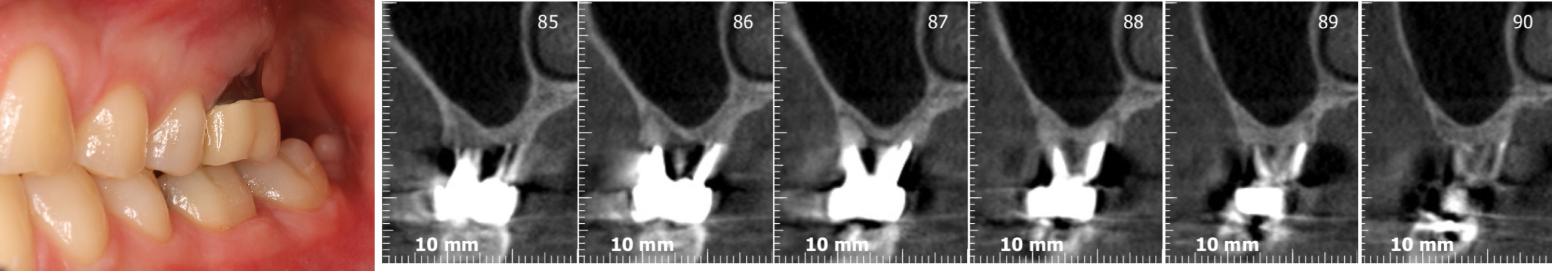 Rehabilitation of #26 with sinus lift prior to extraction - Immediate function