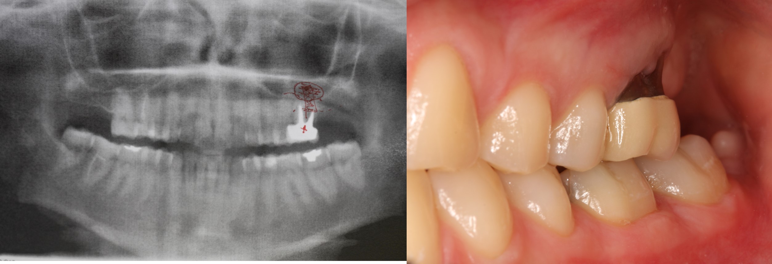 Rehabilitation of #26 with sinus lift prior to extraction - Immediate function