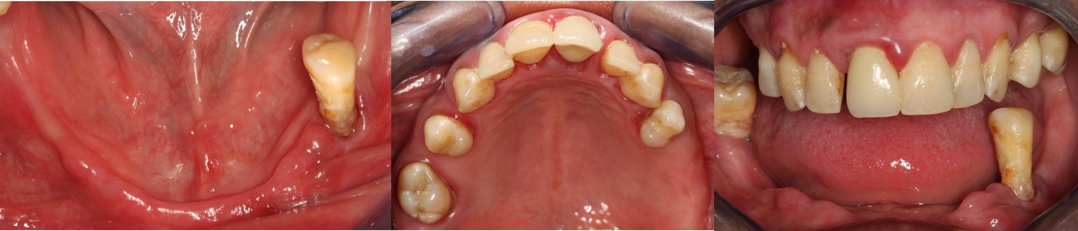 All-on-4 Mandible – Immediate function