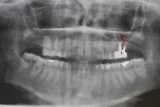 Rehabilitation of #26 with sinus lift prior to extraction - Immediate function