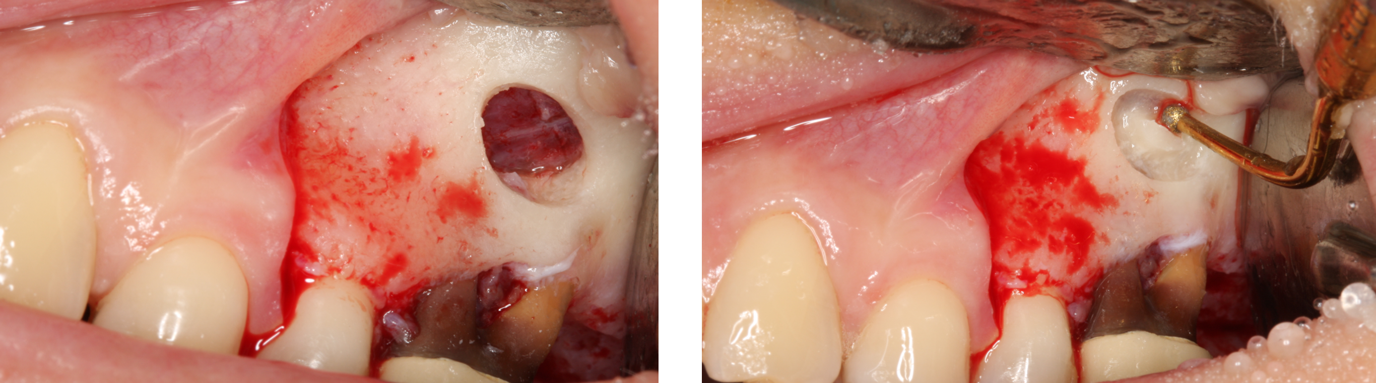 Rehabilitation of #26 with sinus lift prior to extraction - Immediate function