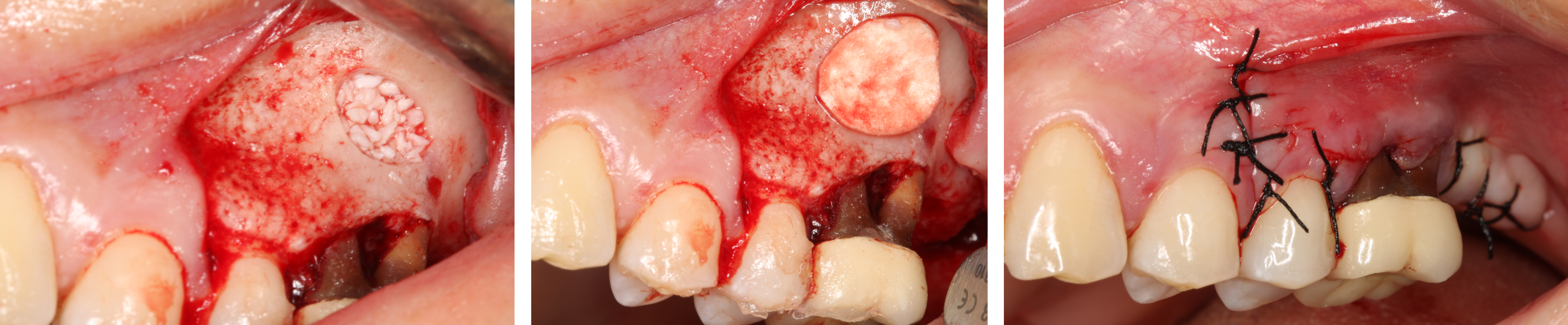 Rehabilitation of #26 with sinus lift prior to extraction - Immediate function