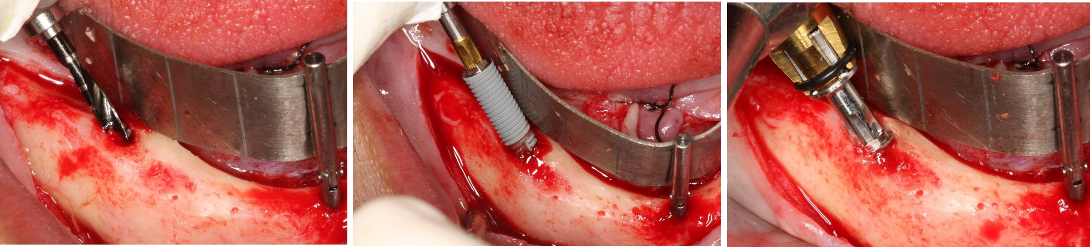 All-on-4 Mandible – Immediate function