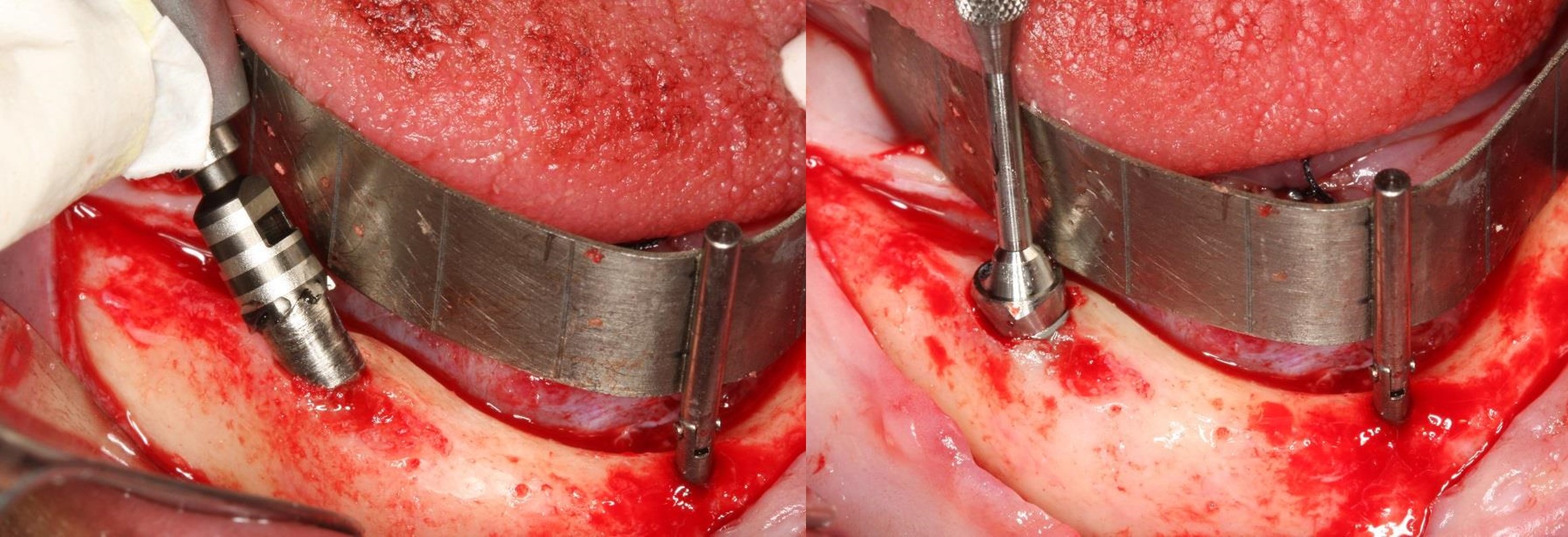 All-on-4 Mandible – Immediate function