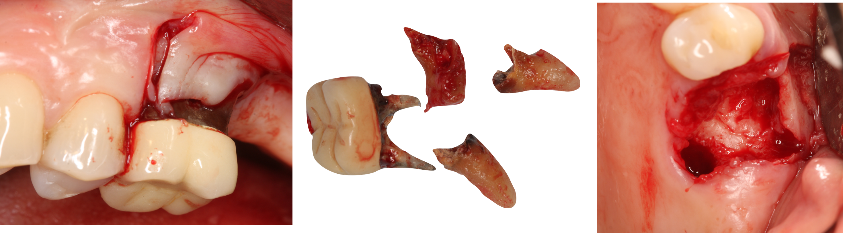 Rehabilitation of #26 with sinus lift prior to extraction - Immediate function