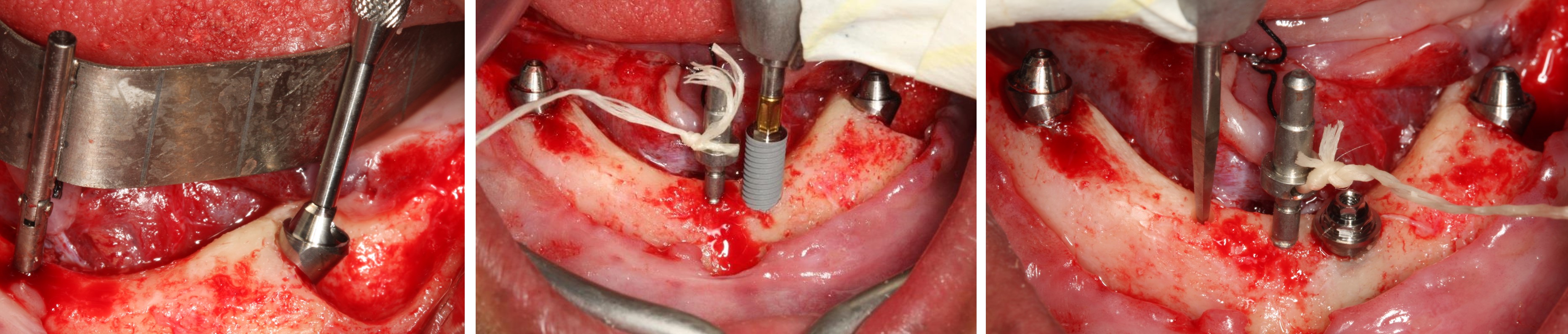 All-on-4 Mandible – Immediate function