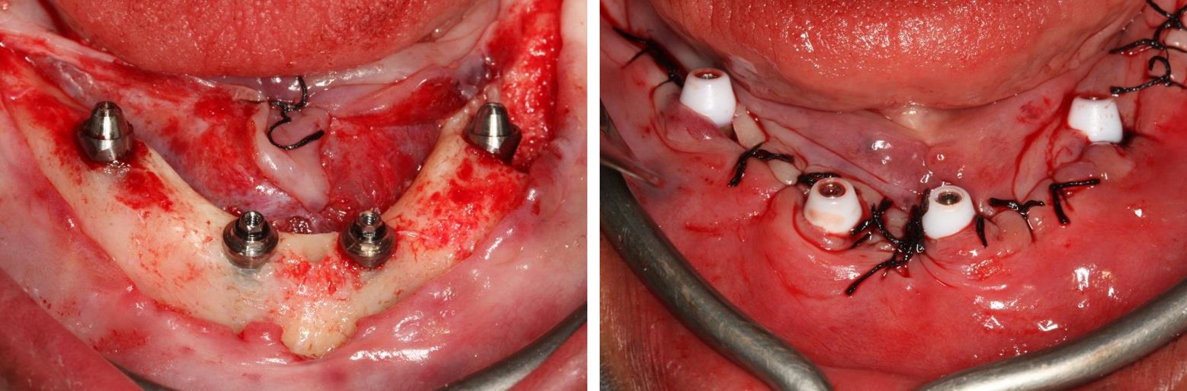 All-on-4 Mandible – Immediate function