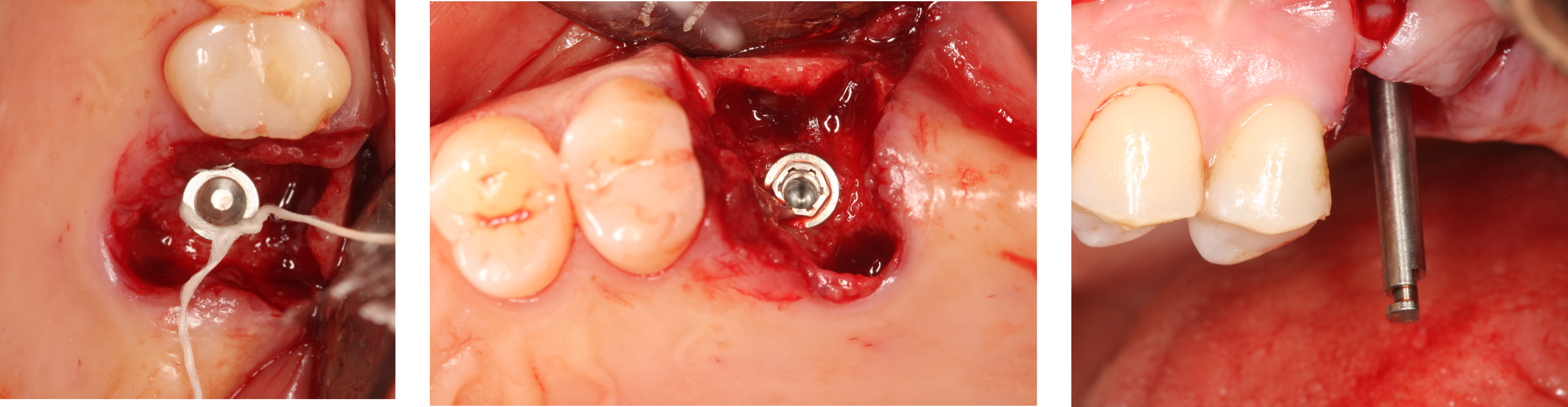 Rehabilitation of #26 with sinus lift prior to extraction - Immediate function