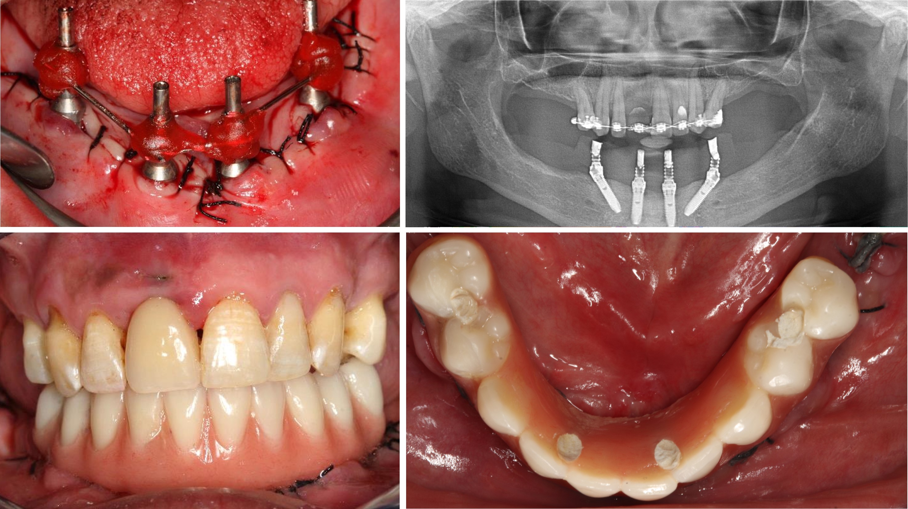 All-on-4 Mandible – Immediate function