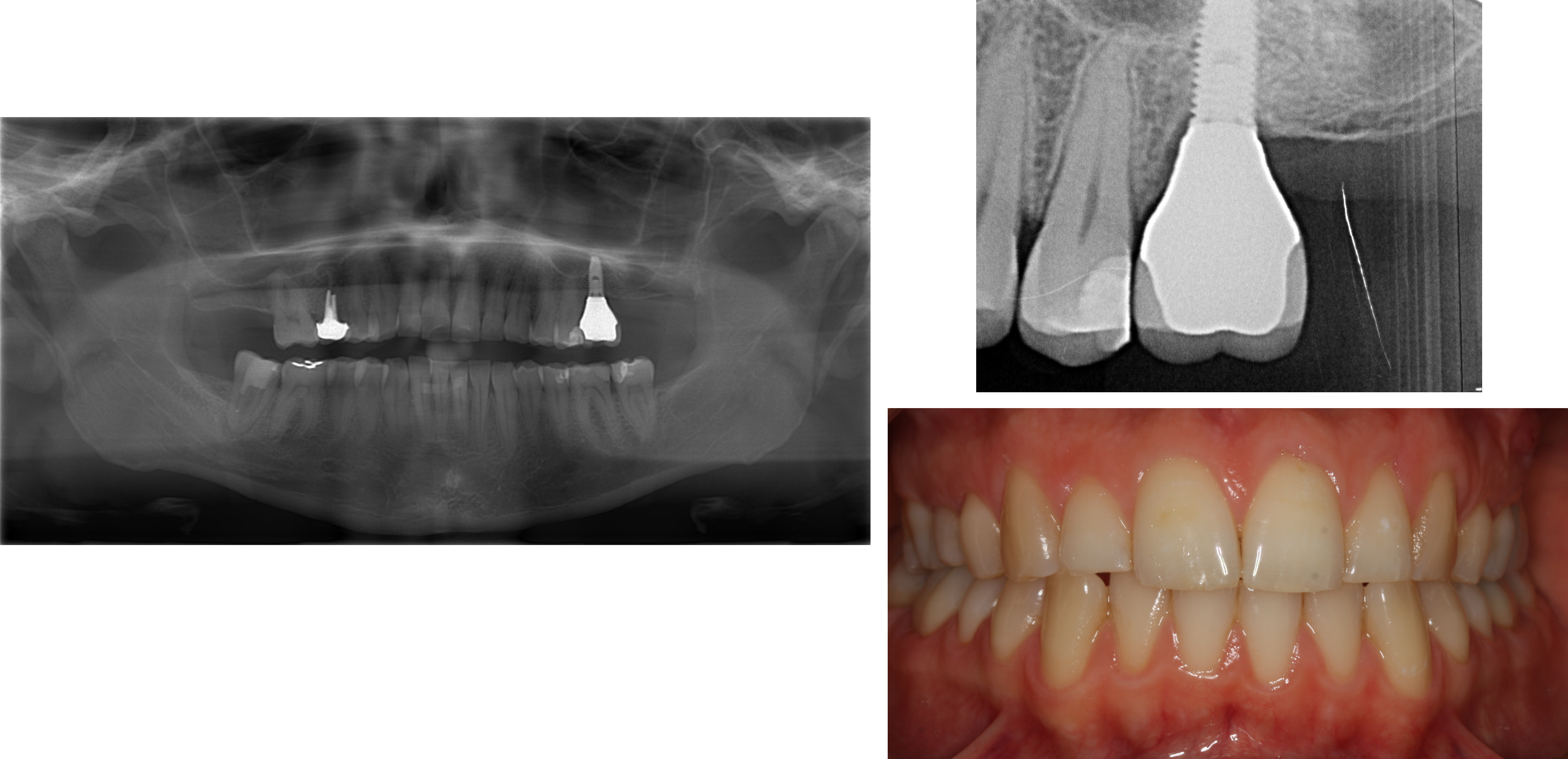 Rehabilitation of #26 with sinus lift prior to extraction - Immediate function